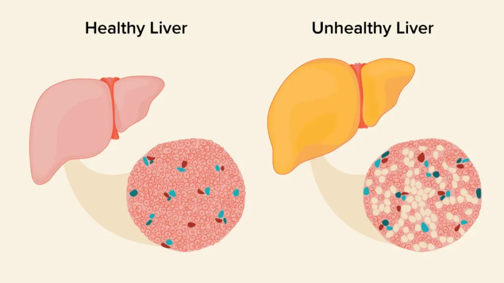 Difference between a healthy liver and unhealthy liver