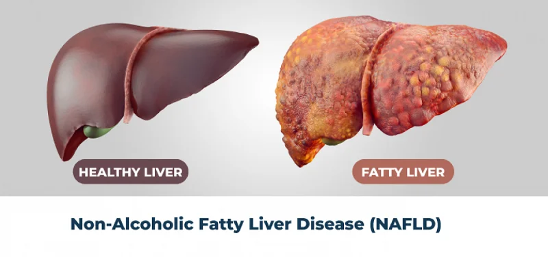 Managing Fatty Liver Disease 3 Fatty liver