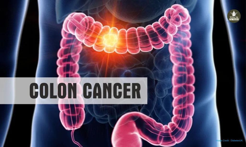 Processed Food Cause Colon Cancer| Responsible 5 Foods | Scientists Warned