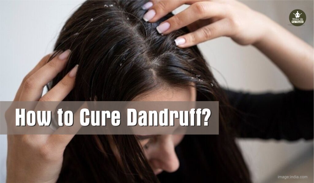 how to cure dandruff cause