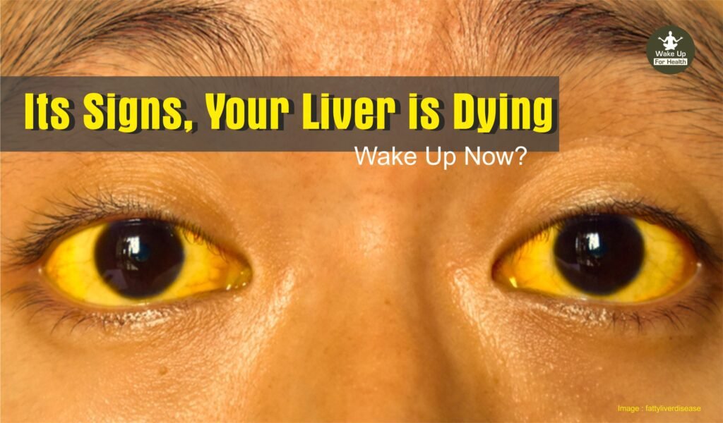 Yellow Eyes: A Sign of Liver Problems 2 Yellow Eyes Are Sign of This Deadly Disease | 7 Signs Your Liver is Dying