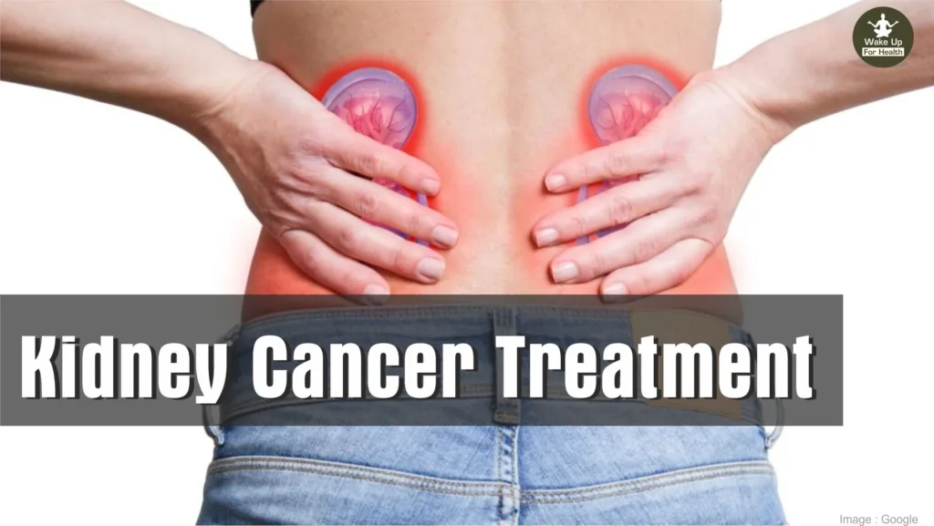 Kidney Cancer Treatment : Symptoms, Types, Causes, Surgery & Therapies