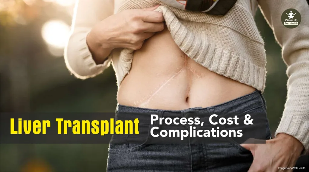 What is Liver Transplant | When Need To Transplant | Process, Cost and Complications | www.wakeupforhealth.coom