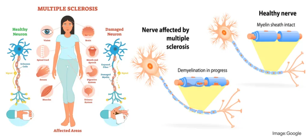 Multiple Sclerosis: Understanding Symptoms and Treatment 2 Multiple Sclerosis - MS Symptoms, Types, Diagnose, Treatment & Diet