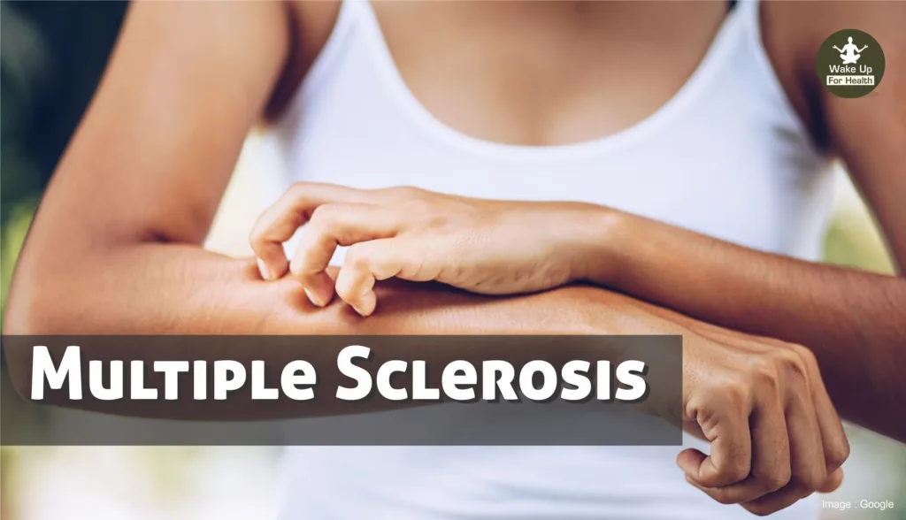 Multiple Sclerosis - MS Symptoms, Types, Diagnose, Treatment & Diet