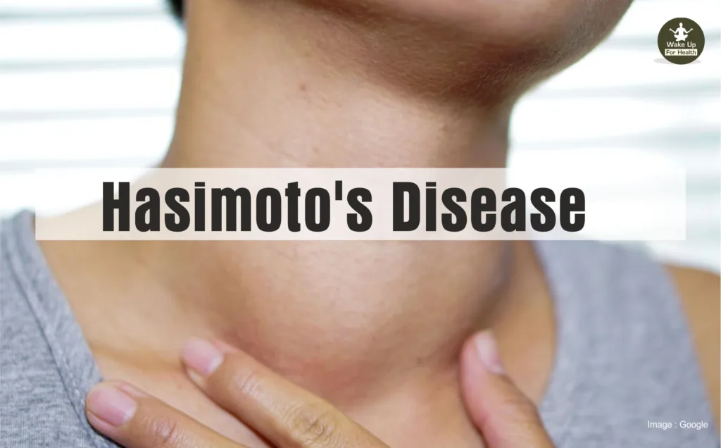 hasimoto diseases