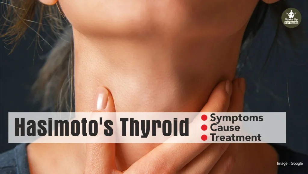 Hashimoto's Thyroiditis: Symptoms, Causes, and Treatments