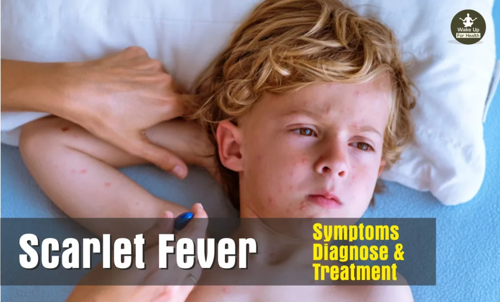 Scarlet Fever: Symptoms, Causes, Diagnose and Treatment