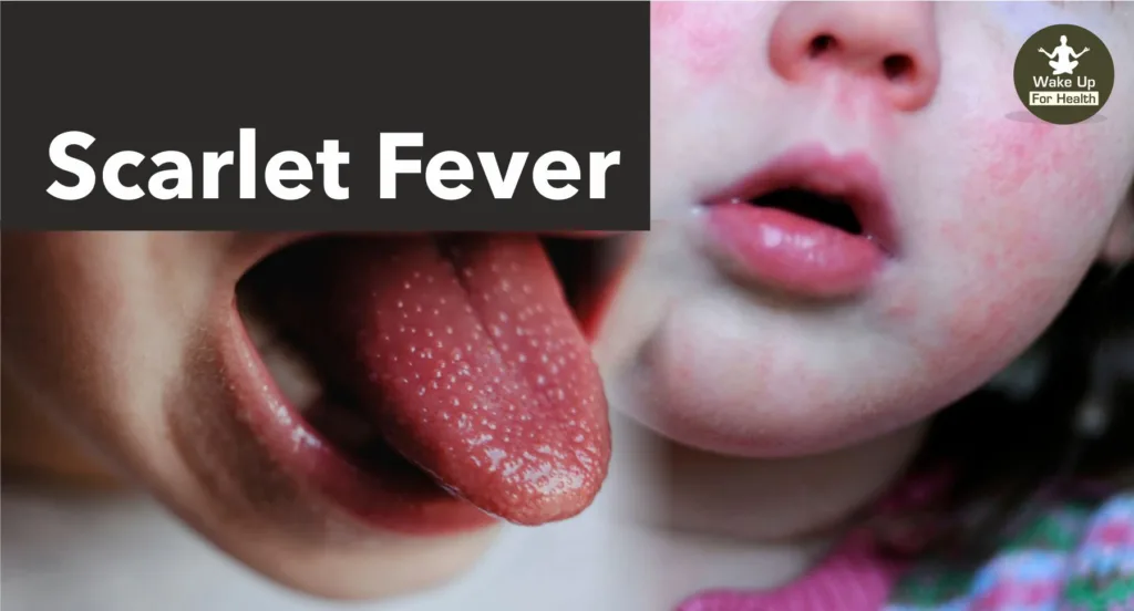 Scarlet Fever : How to Diagnose?