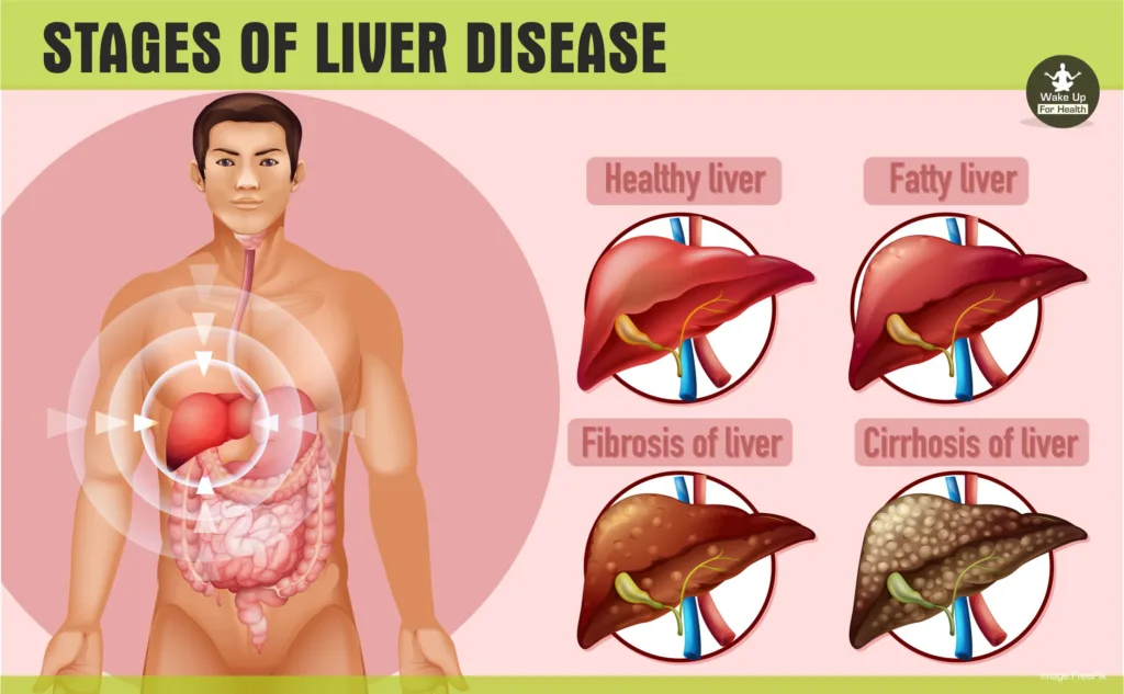 What is Liver Transplant | When Should Move To Transplant | Process, Cost and Complications | 