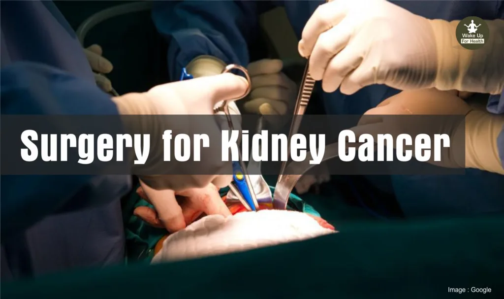 Kidney Cancer: Understanding Symptoms and Treatment 3 Kidney Cancer Treatment? wakeupforhealth.com