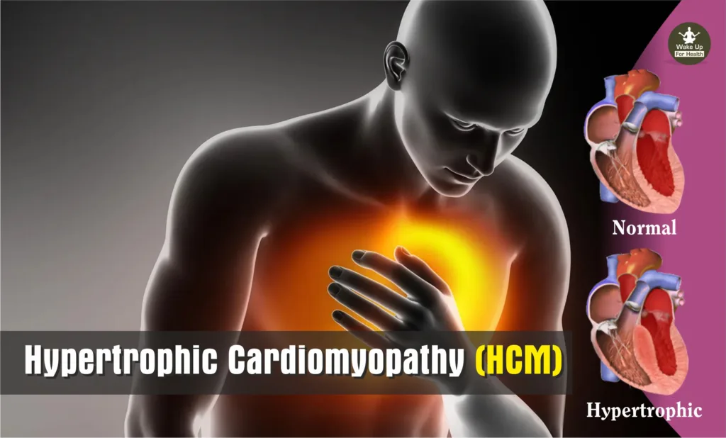 Hypertrophic Cardiomyopathy HCM