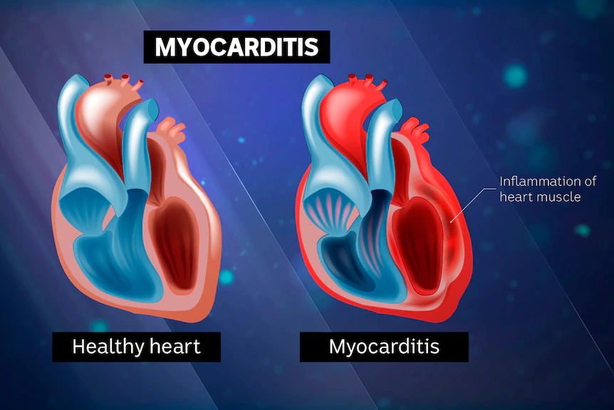 Heart Inflammation: Types, Causes, Symptoms and Treatments