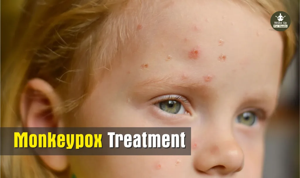 Monkeypox Disease : Symptoms, Causes, Prevention and Treatment