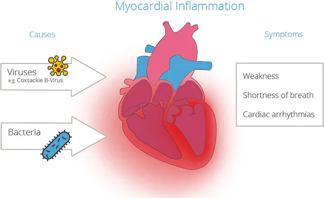 Heart Inflammation: Types, Causes, Symptoms and Treatments