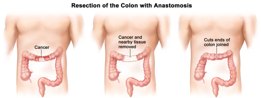 Colorectal Cancer - Why Colon Cancer Occurs, Symptoms, Types and Treatment, Medication 5 rectal cancer,colorectal cancer,colon cancer,colorectal,stage 4 colon cancer,colon cancer treatment,colon cancer screening,colorectal cancer screening,stage 3 colon cancer,adenocarcinoma colon,bowel cancer screening,uspstf colon cancer screening,malignant neoplasm of colon,colon cancer surgery,metastatic colon cancer,colorectal cancer treatment,colonoscopy screening,colorectal carcinoma,rectal cancer treatment,colorectal screening,rectal adenocarcinoma,sigmoid cancer,colon cancer in women,large intestine cancer,types of colon cancer,colon cancer prevention,colonoscopy recommendations,rectal carcinoma,rectal surgery,hereditary nonpolyposis colorectal cancer,stage 3 rectal cancer,colon rectal surgeons,colorectal adenocarcinoma,colon cancer,colorectal cancer,colorectal,colon polyps,stage 4 colon cancer,colonoscopy age,colon cancer treatment,colon pain,colon cancer screening,colorectal cancer screening,adenocarcinoma colon,colon problems,colon surgery,colon spasms,colon pain left side,colon inflammation,colon removal,colon cancer prognosis,sigmoid colon pain,colon health,colon pain right side,colon cancer surgery,colorectal cancer treatment,types of colon polyps,colonoscopy screening,ascending colon pain,