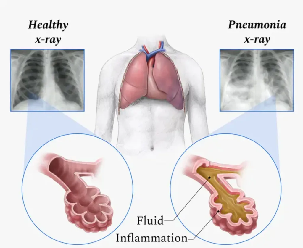 Pneumonia: Causes, Symptoms, Diagnosis & Treatment 3 Pneumonia,pneumonia symptoms,pneumonia treatment,streptococcus pneumoniae,aspiration pneumonia,signs of pneumonia,bronchopneumonia,mycoplasma pneumoniae,bacterial pneumonia,signs that pneumonia is improving,walking pneumonia symptoms,viral pneumonia,pneumonia causes,community acquired pneumonia,symptoms of pneumonia in adults,types of pneumonia,double pneumonia,pneumonia signs and symptoms,interstitial pneumonia,pneumocystis pneumonia,antibiotics for pneumonia,pneumococcal pneumonia,legionella pneumonia,ventilator associated pneumonia,pathophysiology of pneumonia,pneumonia treatment at home,viral pneumonia symptoms,define pneumonia,