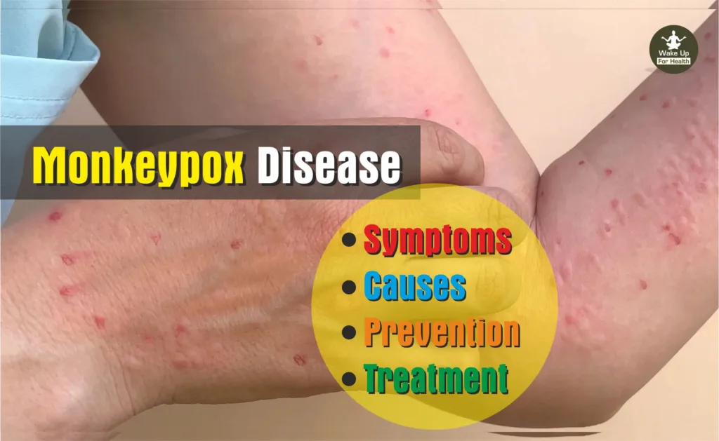 Monkeypox Disease : Symptoms, Causes, Prevention and Treatment