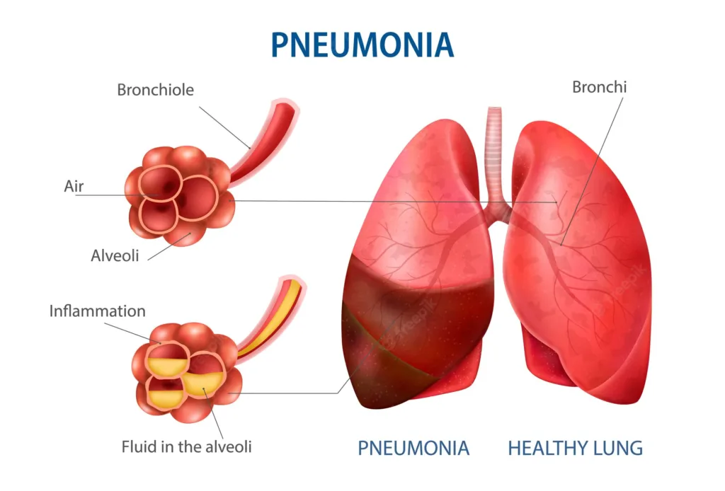 Pneumonia: Causes, Symptoms, Diagnosis & Treatment 2 Pneumonia,pneumonia symptoms,pneumonia treatment,streptococcus pneumoniae,aspiration pneumonia,signs of pneumonia,bronchopneumonia,mycoplasma pneumoniae,bacterial pneumonia,signs that pneumonia is improving,walking pneumonia symptoms,viral pneumonia,pneumonia causes,community acquired pneumonia,symptoms of pneumonia in adults,types of pneumonia,double pneumonia,pneumonia signs and symptoms,interstitial pneumonia,pneumocystis pneumonia,antibiotics for pneumonia,pneumococcal pneumonia,legionella pneumonia,ventilator associated pneumonia,pathophysiology of pneumonia,pneumonia treatment at home,viral pneumonia symptoms,define pneumonia,