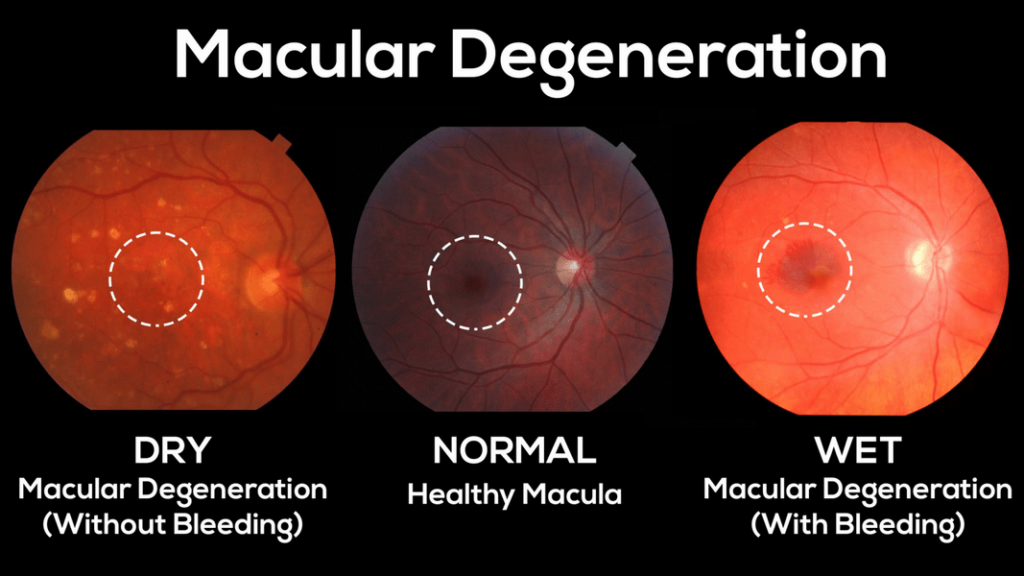 Macular Degeneration (AMD) : Symptoms, Causes, Treatment & Lifestyle 3 Ages Macular Degeneration (AMD) : Symptoms, Causes, Treatment & Lifestyle
Armd,wet macular degeneration,macular degeneration treatment,age related macular degeneration,dry macular degeneration,drusen eye,dry amd,wet amd,degenerative eye disease,myopic degeneration,new treatment for macular degeneration 2023,amd eye disease,macular drusen,dry macular degeneration treatment,myopic macular degeneration,amd eye condition,age macular degeneration,wet amd treatment,new treatment for dry macular degeneration 2023,macular degeneration prevention,amd treatment,
