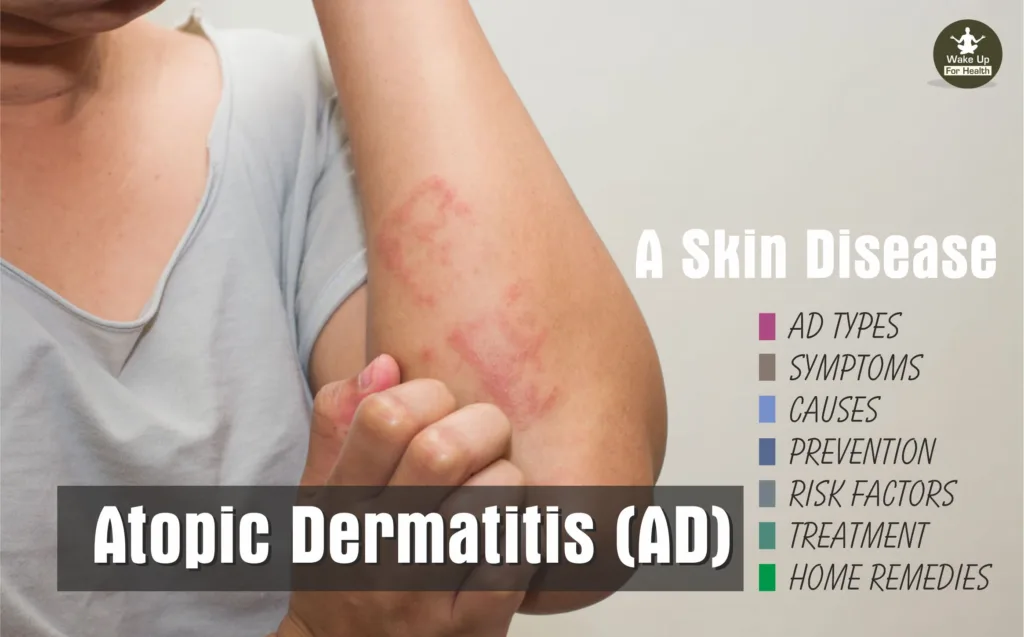Atopic Dermatitis AD Treatment and Symptoms