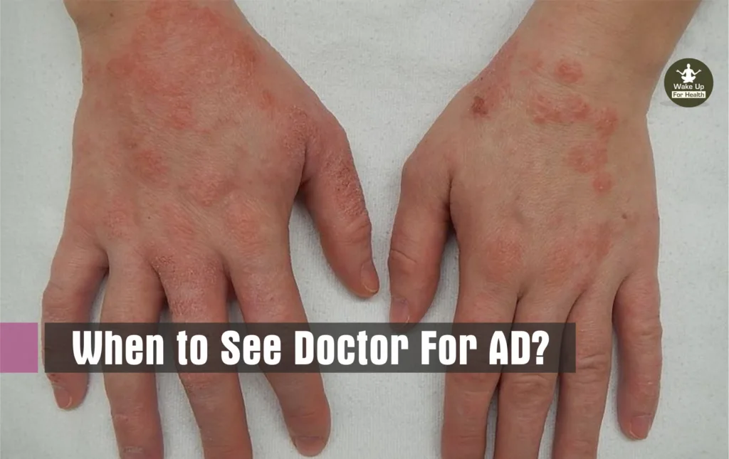 Atopic Dermatitis (AD) : Symptoms, Causes, Types, Prevention and Treatment 2 Atopic Dermatitis (AD) : Symptoms, Causes, Types, Prevention and Treatment : www.wakeupforhealth.com #fyp #foryou #foryoupage