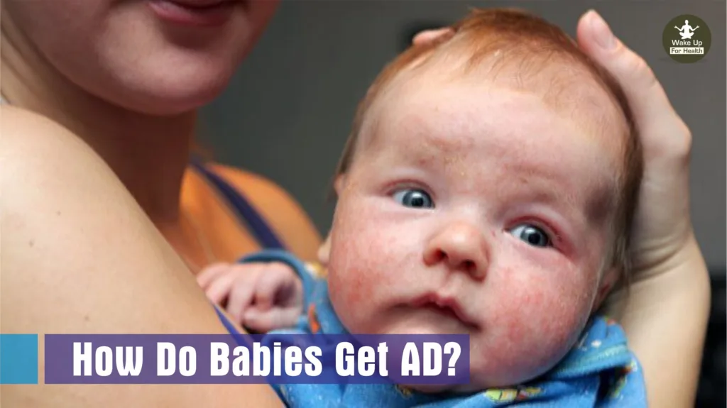 Atopic Dermatitis (AD) : Symptoms, Causes, Types, Prevention and Treatment 4 Atopic Dermatitis (AD) : Symptoms, Causes, Types, Prevention and Treatment : www.wakeupforhealth.com #fyp #foryou #foryoupage