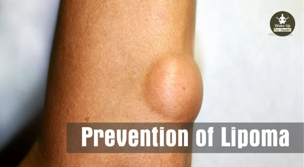 Lipoma Explained: Types, Causes, Symptoms, Treatment, Diet - WFH 2 Prevention of Lipoma, Lipoma,lipoma removal,lipoma treatment,lipoma meaning,lipoma causes,fibrolipoma,lipoma symptoms,lipoma removal cost,new treatment for lipoma,fatty tumor,lipoma on back,my lipomas are gone,lipoma treatment without surgery,lipoma surgery,lipoma surgery side effects,lipoma removal near me,lipoma cancer,painful lipoma,lipoma neck,multiple lipomas,lipoma tumor,lipoma disease,intramuscular lipoma,multiple lumps in stomach fat,fatty lumps under skin,fatty lump,fatty cyst,lipoma abdominal,lipoma lump,lipoma on forehead,fatty tissue under skin,lipoma on head,familial multiple lipomatosis,lipoma homeopathic medicine,breast lipoma,lipoma on leg,lipoma on shoulder,lipoma behind ear,atypical lipomatous tumor,