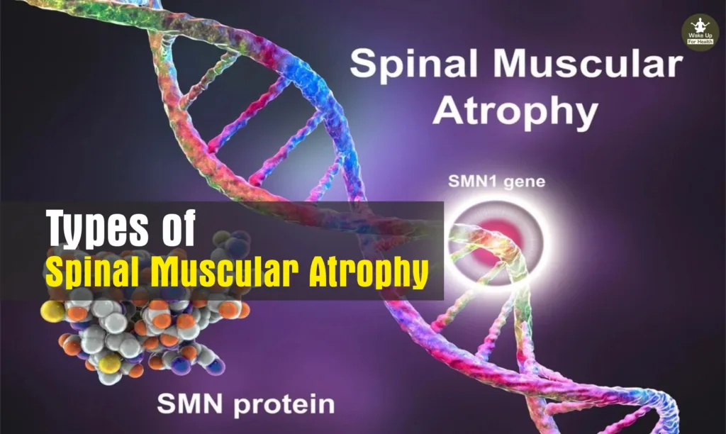 Spinal Muscular Atrophy Treatment | SMA Types, SMA Causes, Treatment & Medicine 2 spinal muscular atrophy,spinal muscular atrophy treatment,muscular atrophy,sma type 1,sma disease,sma type 2,spinal muscular atrophy type 1,spinal muscular atrophy symptoms,sma 1 disease,werdnig hoffmann disease,sma treatment,sma symptoms,spinal muscular atrophy type 2,sma carrier,sma disease treatment,sma type 1 disease,sma type 1 treatment cost,sma type 3,sma disease full form,sma medical,spinal muscular atrophy life expectancy,sma life expectancy,spinal atrophy,sma symptoms during pregnancy,sma types,sma type 1 treatment,sma diagnosis,sma spinal muscular atrophy,sma disease symptoms,spinal muscular atrophy type 3,spinal muscular atrophy carrier,sma type 4,sma type 1 symptoms,sma illness,spinal muscular atrophy causes,spinal muscular,muscular atrophy symptoms,spinal muscular atrophy types,spinal bulbar muscular atrophy,sma cure,sma type 1 life expectancy,spinal muscular atrophy type 4,spinobulbar muscular atrophy,spinal muscular atrophy treatment price,