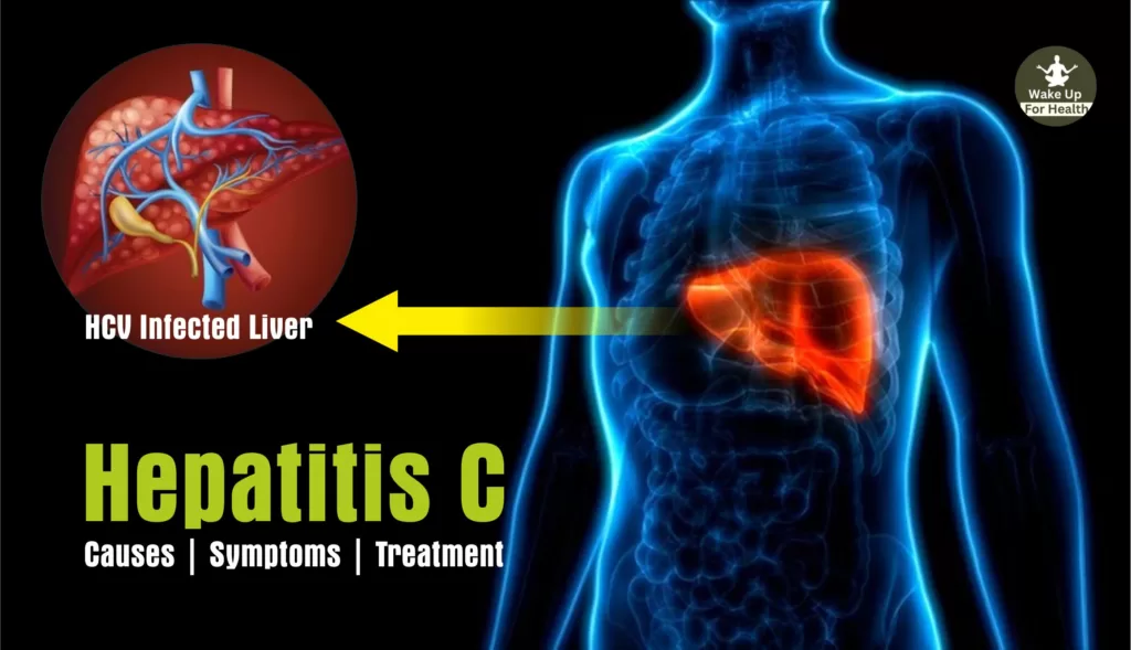 hepatitis C