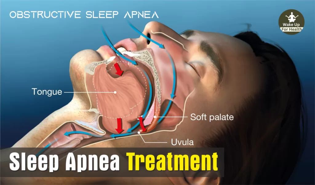 Sleep Apnea Treatment wakeupforhealth.com