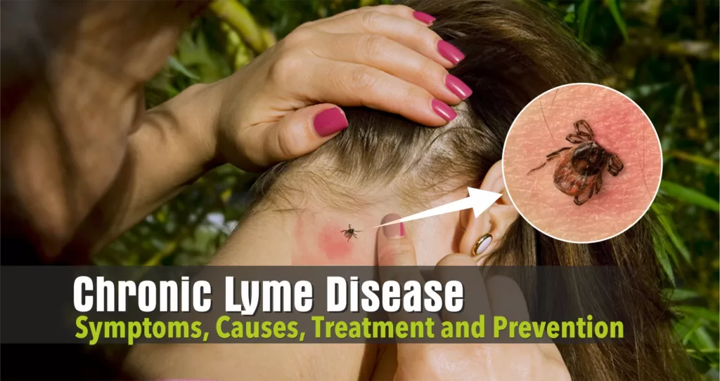 chronic lyme disease 2023, lyme treatment, latest treatment for lyme,